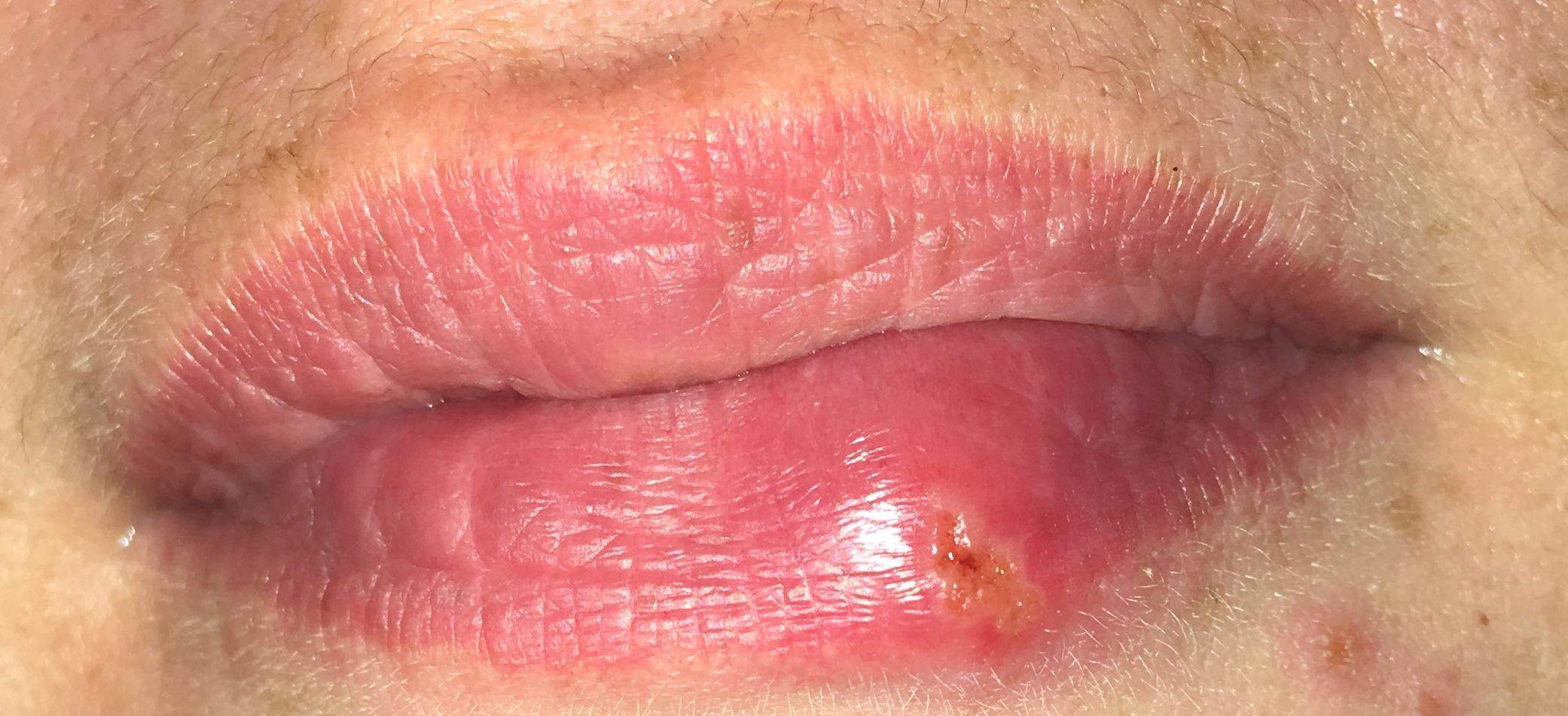 Was ist das an der Lippe? Herpes oder Abszess? (Gesundheit und Medizin, Hautkrankheit)