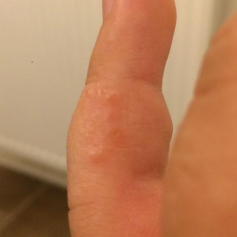 Das ist mein Finger  - (Schmerzen, Haut, Finger)