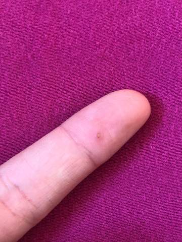 Was ist das an meinem Finger (siehe Bild)?