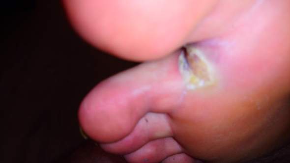 Was Ist Das An Meinem Fuss Gesundheit Und Medizin Fusse Was Ist Das An Meinem Fuss Gesundheit Und Medizin Fusse