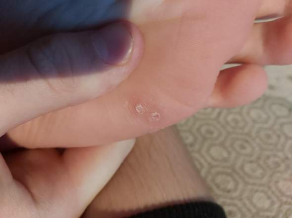 Was ist das an meinem Fuß und wie behandle ich es?