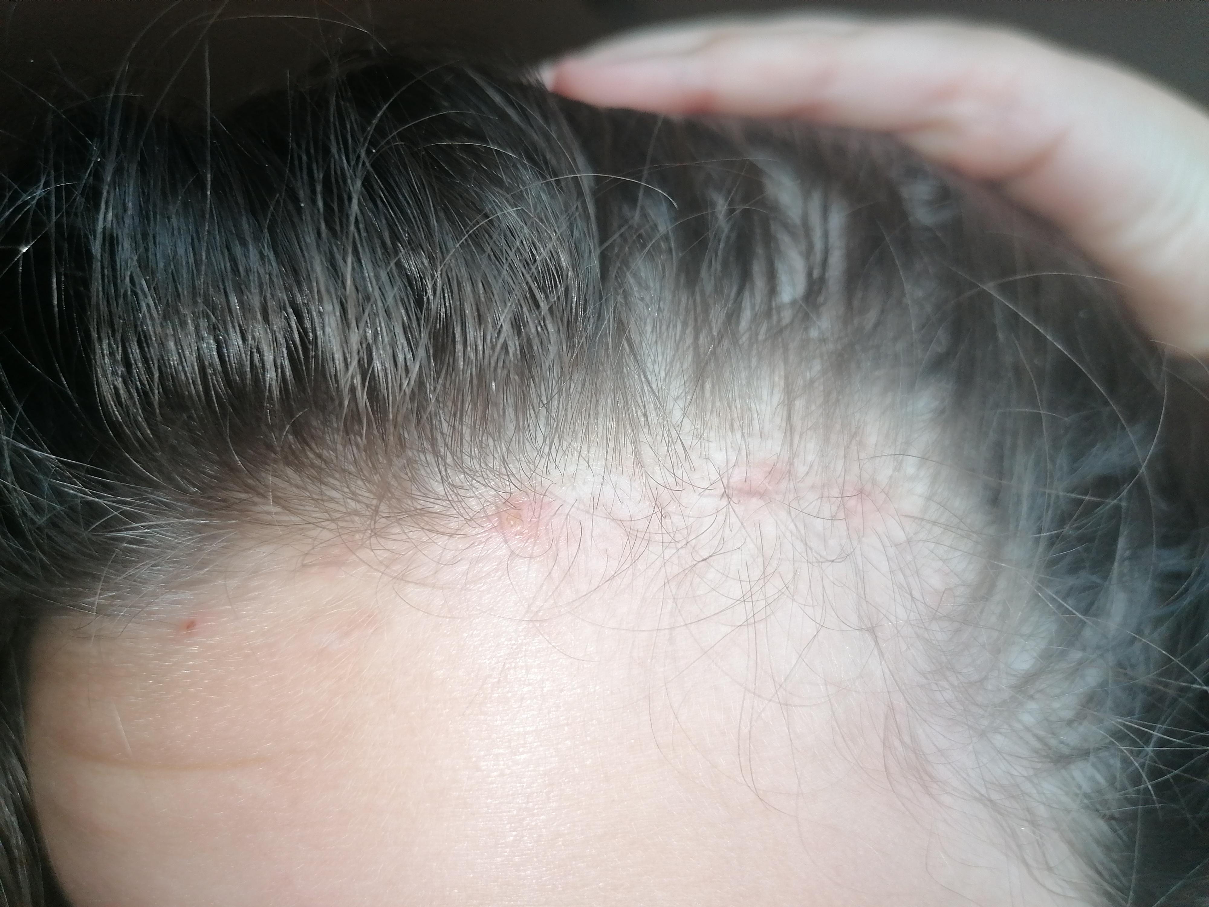 Was ist das an meinem Haaransatz/Pickel? (Gesundheit und Medizin, Haare, Beauty)