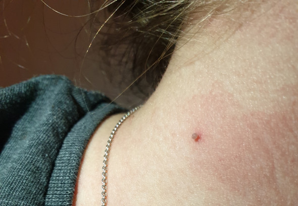 Was Ist Das An Meinem Hals Warze Haut Warzenbehandlung Was Ist Das An Meinem Hals Warze Haut Warzenbehandlung