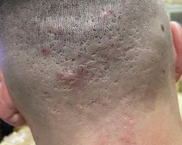 Was ist das An meinem Hinterkopf Aknenarben? (Hautpflege, Akne) pickel hinterkopf
