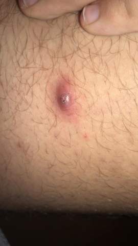 was ist das an meinem innenschenkel