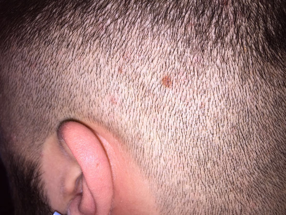 Was ist das an meinem Kopf - pickel? (Muttermal) pickel hinterkopf