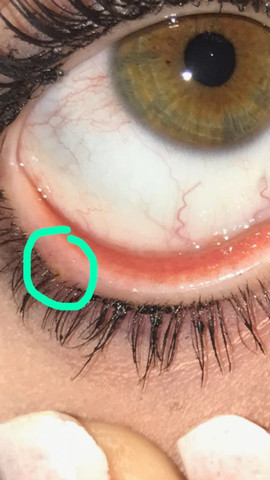 Was Ist Das An Meinem Unterenn Wimpernkranz Siehe Foto Gesundheit Und Medizin Gesundheit Schmerzen Was Ist Das An Meinem Unterenn Wimpernkranz Siehe Foto Gesundheit Und Medizin Gesundheit Schmerzen