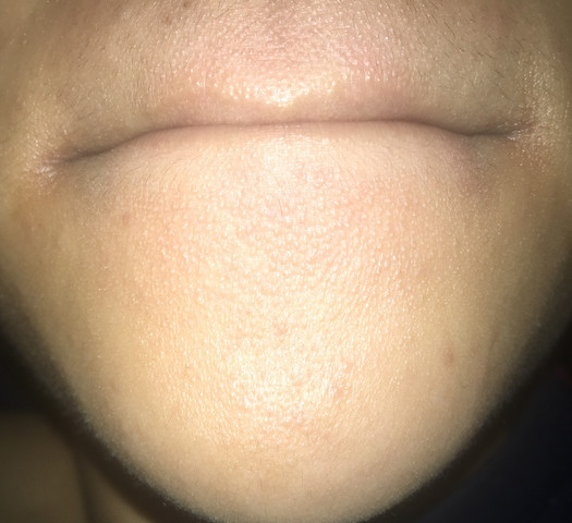 Was Ist Das An Meinen Lippen Und Kinn Madchen Haut Tipps