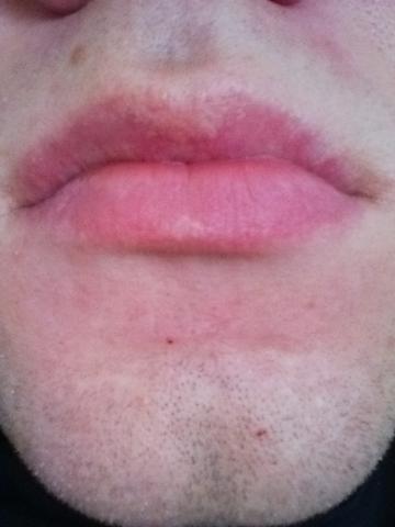 Was ist das? - (Krankheit, Lippe)