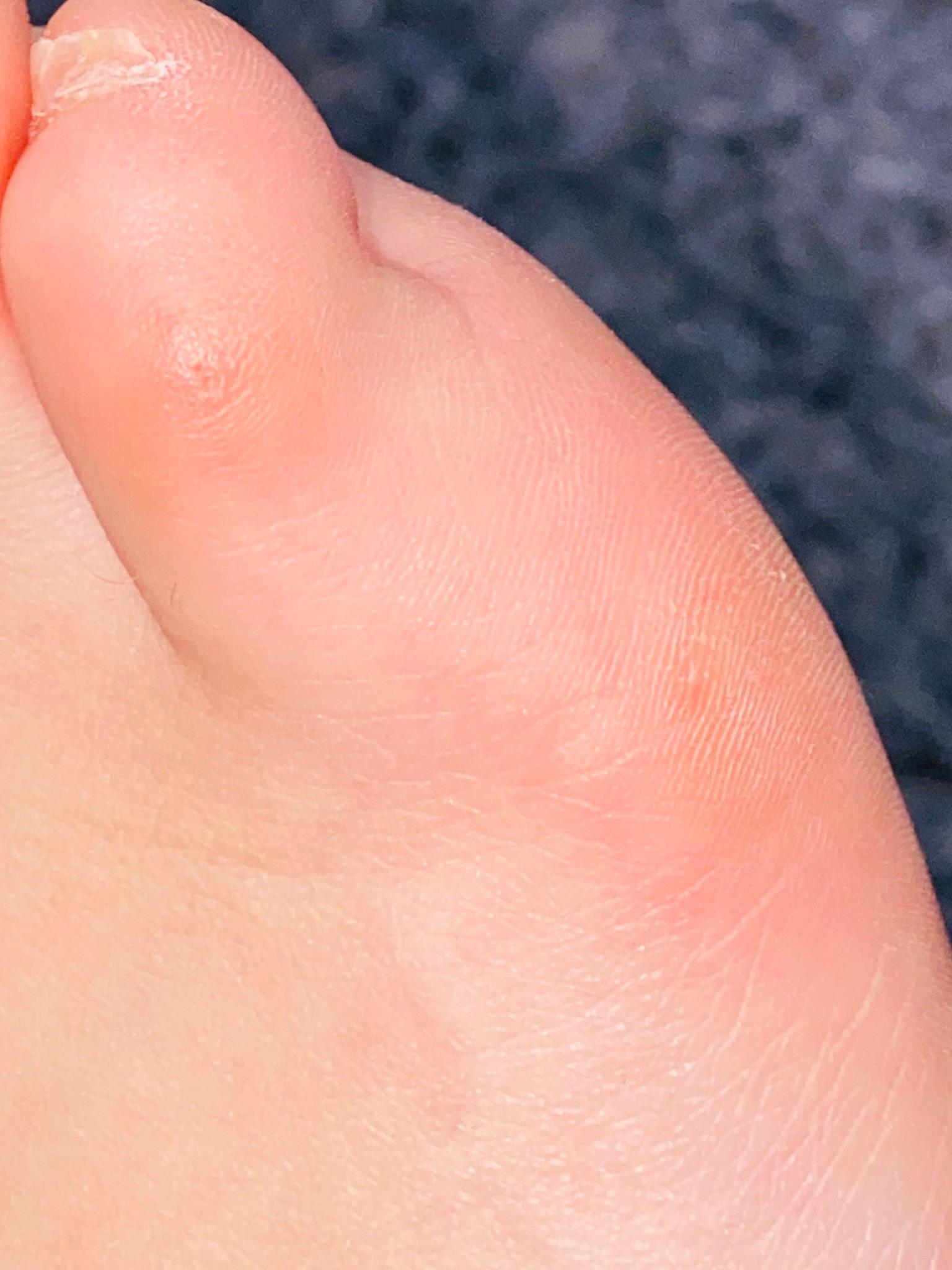 was ist das an meinen zehen? (Gesundheit und Medizin, Gesundheit, Angst)