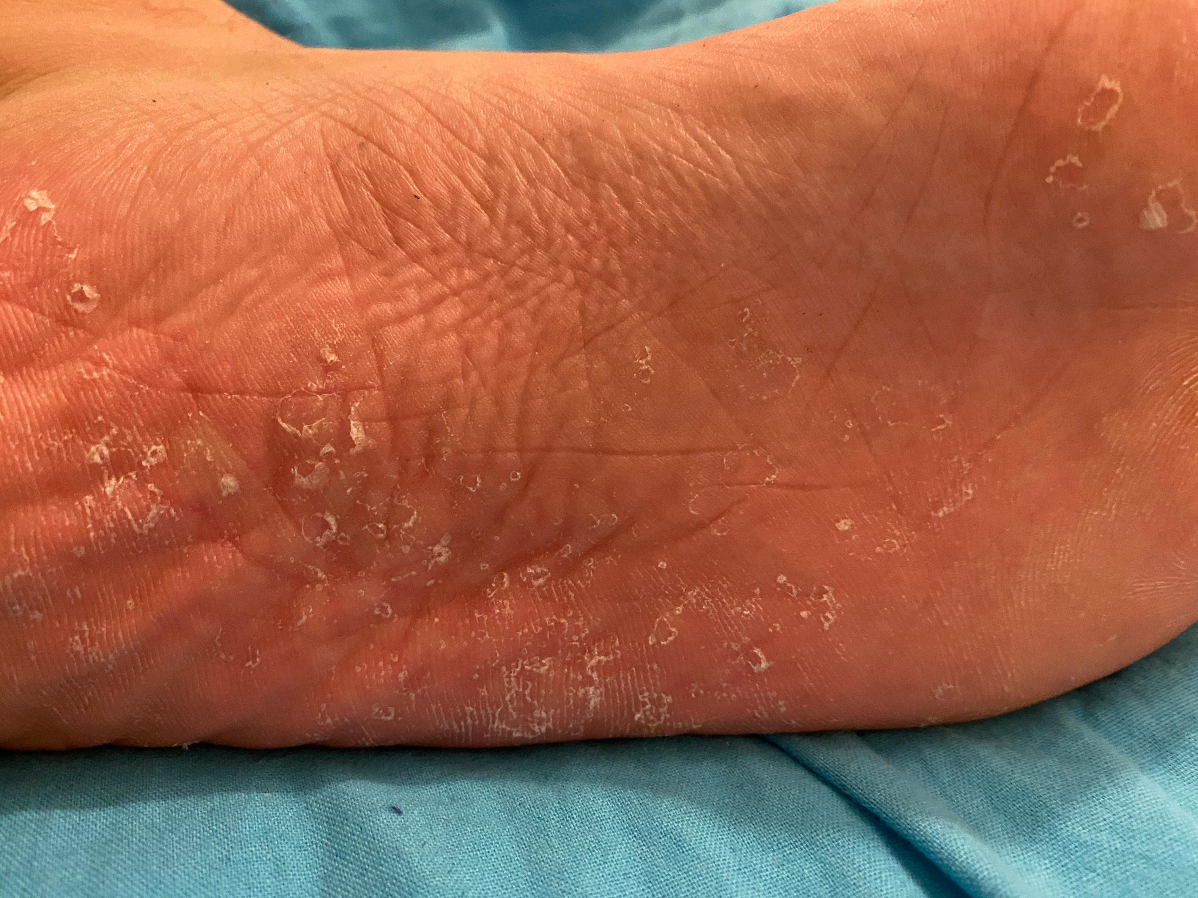 was ist das an meiner Fußsohle? (Füße)