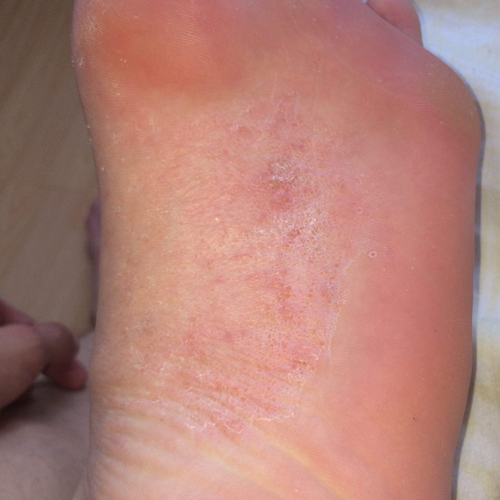 Was ist das an meiner Fußsole? (Gesundheit und Medizin, Füße, Ausschlag)