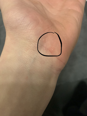 Was ist das an meiner hand wie Pickel? pickel an hand