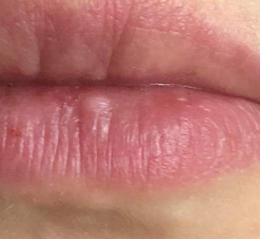 44+ Weisse punkte auf der lippe bilder , Was ist das an meiner Lippe? (Gesundheit und Medizin)