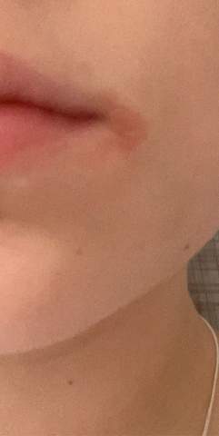 Was Ist Das An Meiner Lippe Billd Gesundheit Und Medizin Pflege