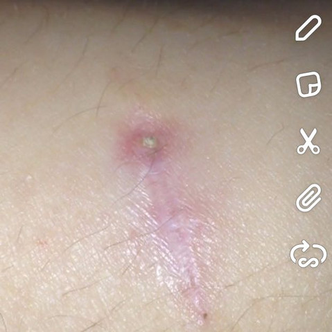 Was Ist Das An Meiner Narbe Am Hand Gelenk Gesundheit Und Medizin Gesundheit Korper Was Ist Das An Meiner Narbe Am Hand Gelenk Gesundheit Und Medizin Gesundheit Korper