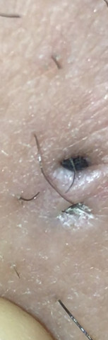 Was Ist Das An Seinem Oberschenkel Haut Loch