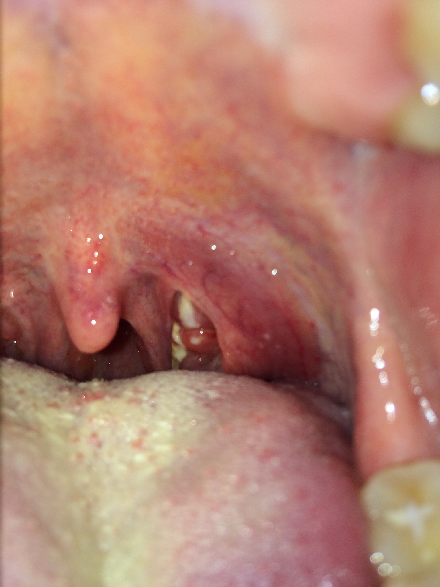 Was ist das auf den Mandeln? (Arzt, Nase, Hals) Was ist das auf den Mandeln? (Arzt, Nase, Hals)