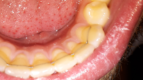 Innenseite der Zähne - (Zähne, Zahnstein)