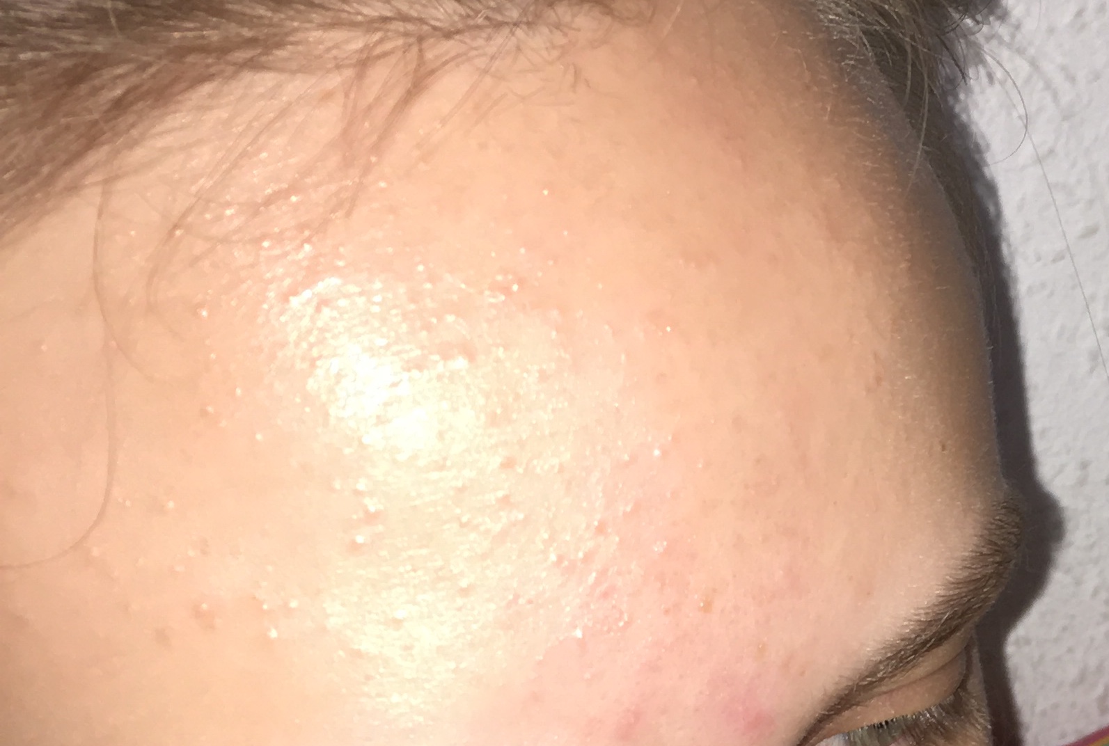 Was ist das auf der Stirn? (Gesundheit und Medizin, Pickel, Akne) pickel an stirn