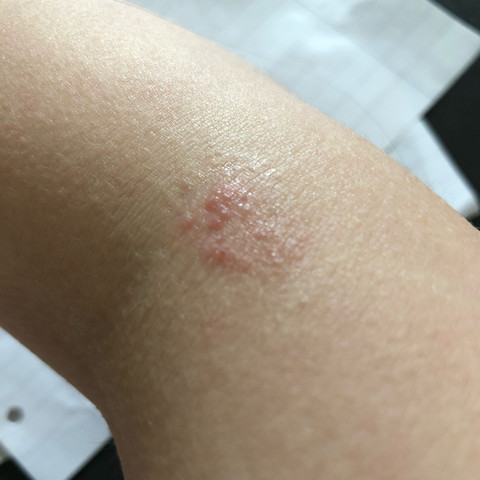 Was Ist Das Auf Meinem Arm Juckreiz Gesundheit Und Medizin Ausschlag Hautkrebs Was Ist Das Auf Meinem Arm Juckreiz Gesundheit Und Medizin Ausschlag Hautkrebs