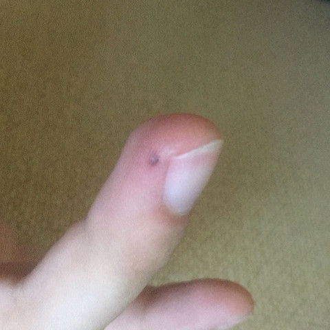 Was Ist Das Auf Meinem Finger Roter Fleck Gesundheit Und Medizin Haut Verletzung Was Ist Das Auf Meinem Finger Roter Fleck Gesundheit Und Medizin Haut Verletzung