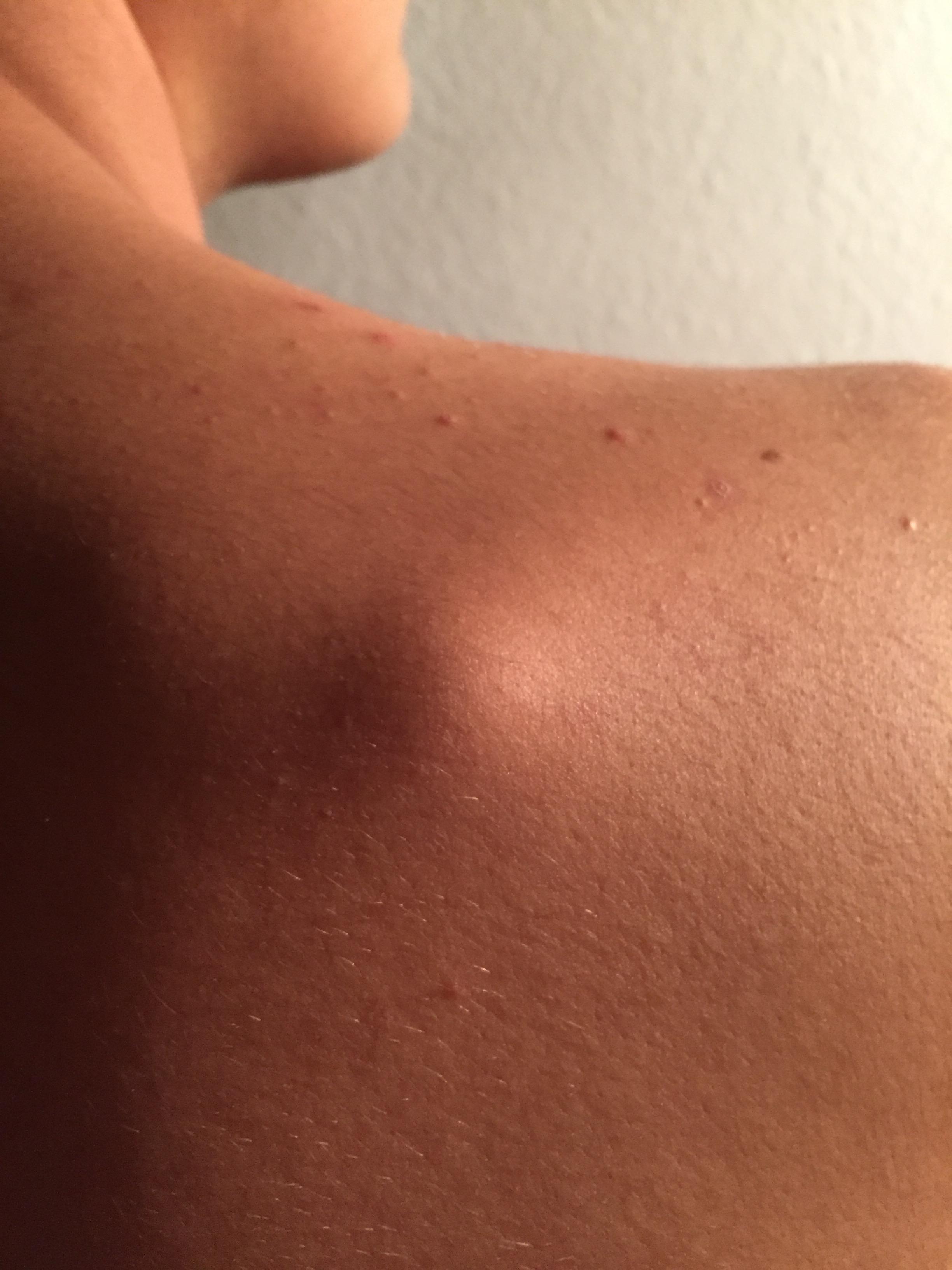 Was Ist Das Auf Meinem Rucken 25 10 2019 Gesundheit Und Medizin Gesundheit Physiologie Was Ist Das Auf Meinem Rucken 25 10 2019 Gesundheit Und Medizin Gesundheit Physiologie