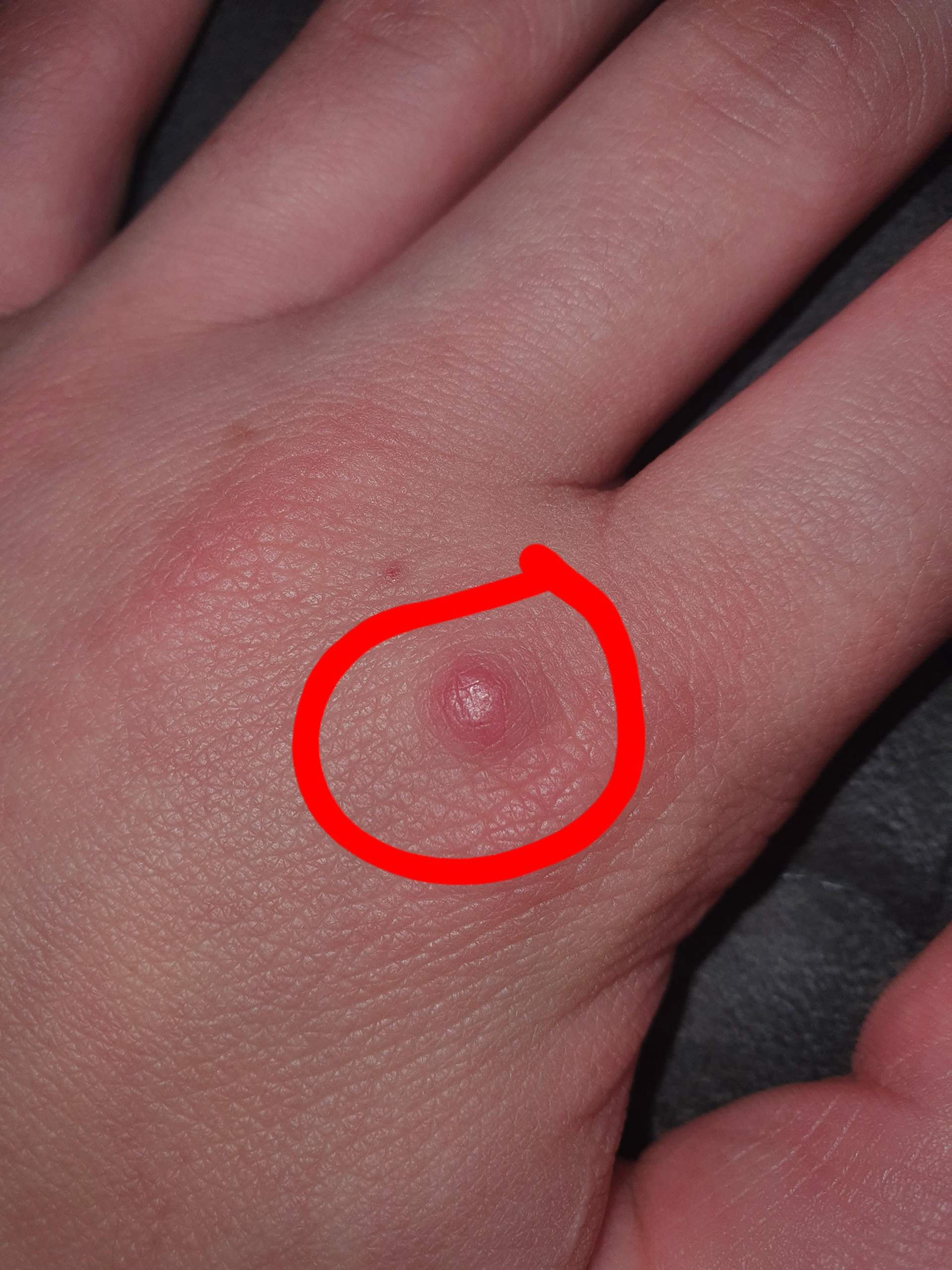 Was ist das auf meiner Hand? (Gesundheit und Medizin, Gesundheit, Pickel) Was ist das auf meiner Hand? (Gesundheit und Medizin, Gesundheit, Pickel)