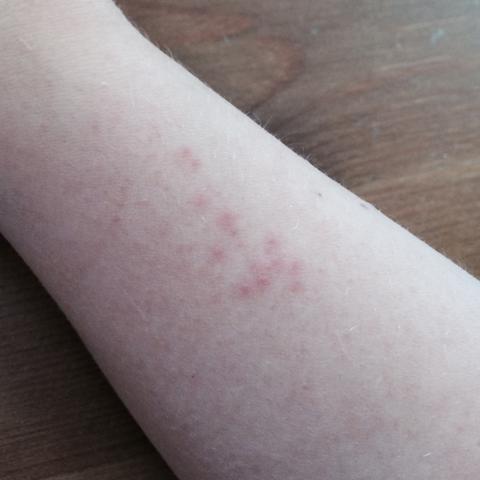 Rote Punkte auf dem Arm - (Allergie, Rötung)