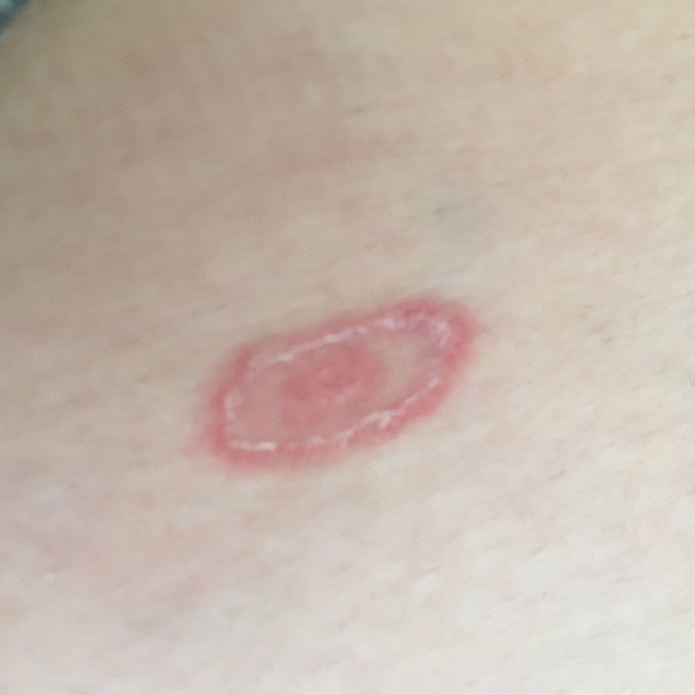 Was ist das für ein Fleck auf meiner Haut? (Flecken, Hautkrankheit) Was ist das für ein Fleck auf meiner Haut? (Flecken, Hautkrankheit)