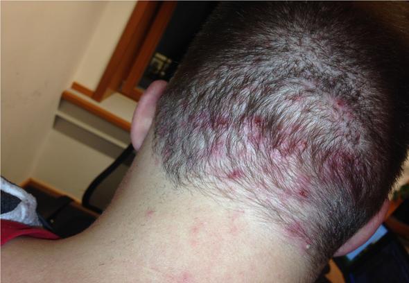 Was ist das auf meiner Kopfhaut? Komische Stellen? (Dermatologie)