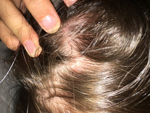 Was ist das auf meiner Kopfhaut? (Roter Fleck)? (Dermatologie)