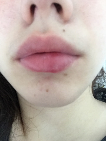 Was Ist Das Auf Meiner Lippe Blase Was Ist Das Auf Meiner Lippe Blase