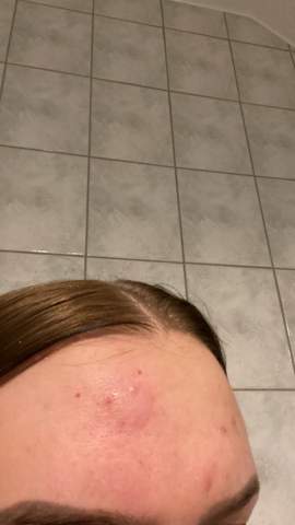Was ist das auf meiner Stirn?
