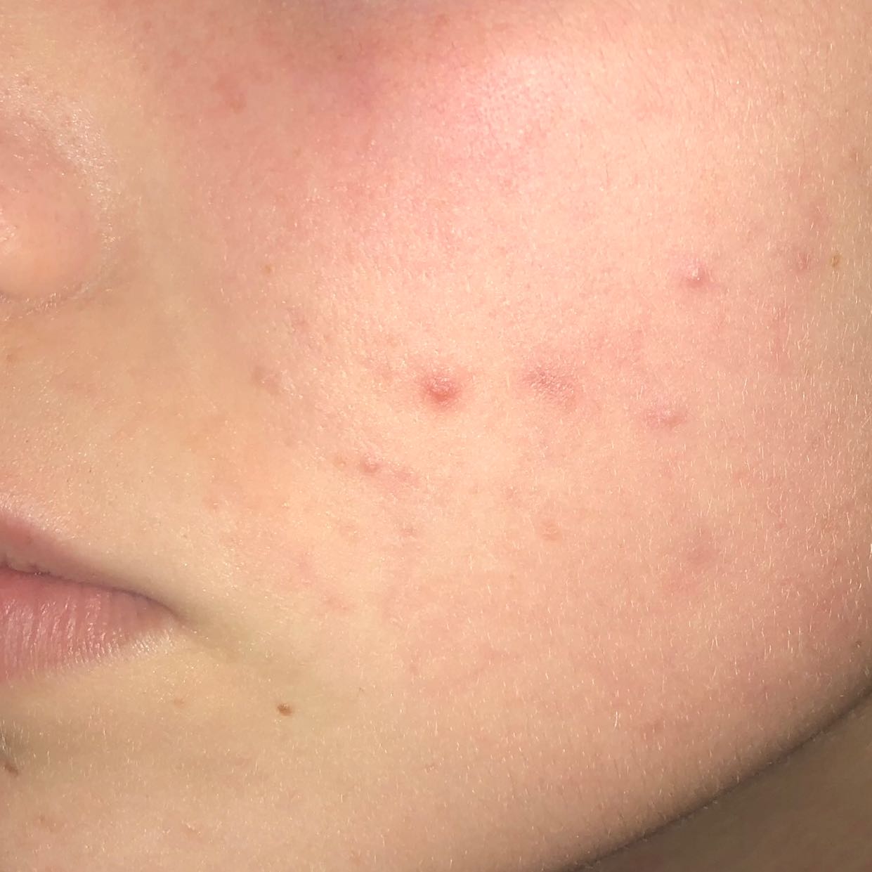 pickel in der wange innen pickel in der wange innen