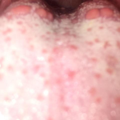 Was Ist Das Auf Meiner Zunge O O Pickel Was Ist Das Auf Meiner Zunge O O Pickel