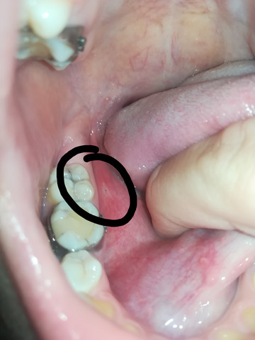 Was Ist Das Auf Meiner Zunge Weiss Mit Riss Gesundheit Und Medizin Gesundheit Medizin Was Ist Das Auf Meiner Zunge Weiss Mit Riss Gesundheit Und Medizin Gesundheit Medizin