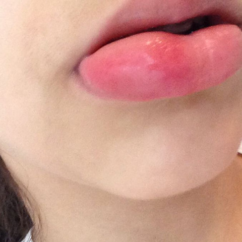 Lippen geschwollene Schwellung der
