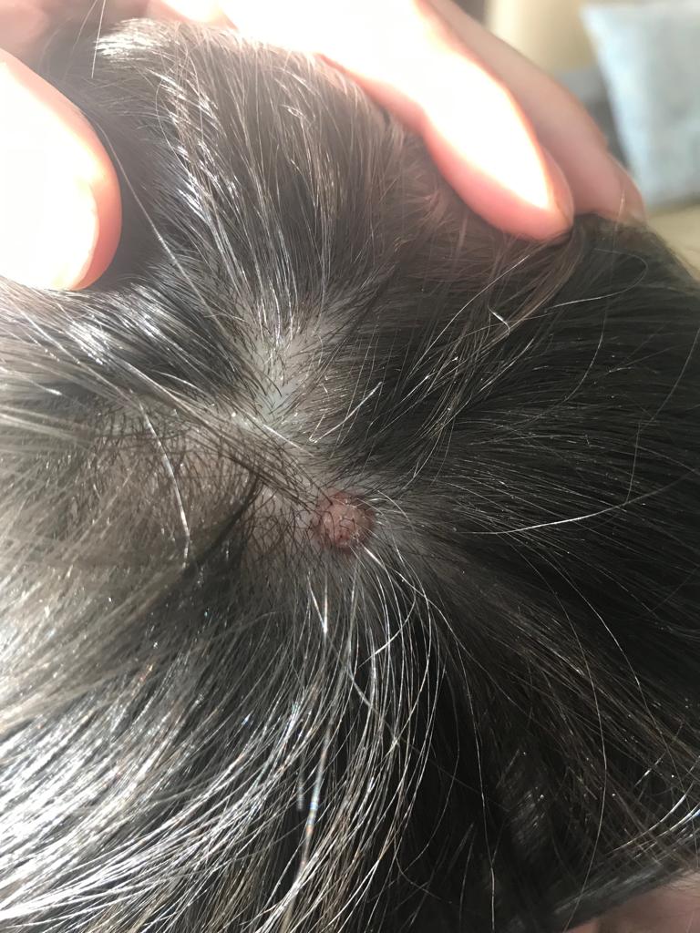 Was ist das auf/an meiner Kopfhaut? (Gesundheit und Medizin, Gesundheit