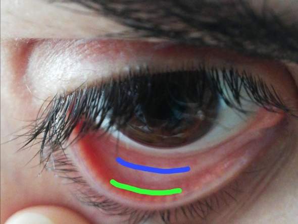 Was Ist Das Augeninnenlid Gesundheit Und Medizin Medizin Augen Was Ist Das Augeninnenlid Gesundheit Und Medizin Medizin Augen