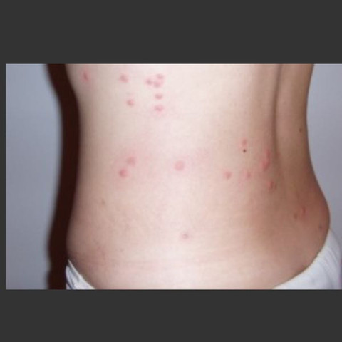 Flöhe loswerden Flöhe loswerden