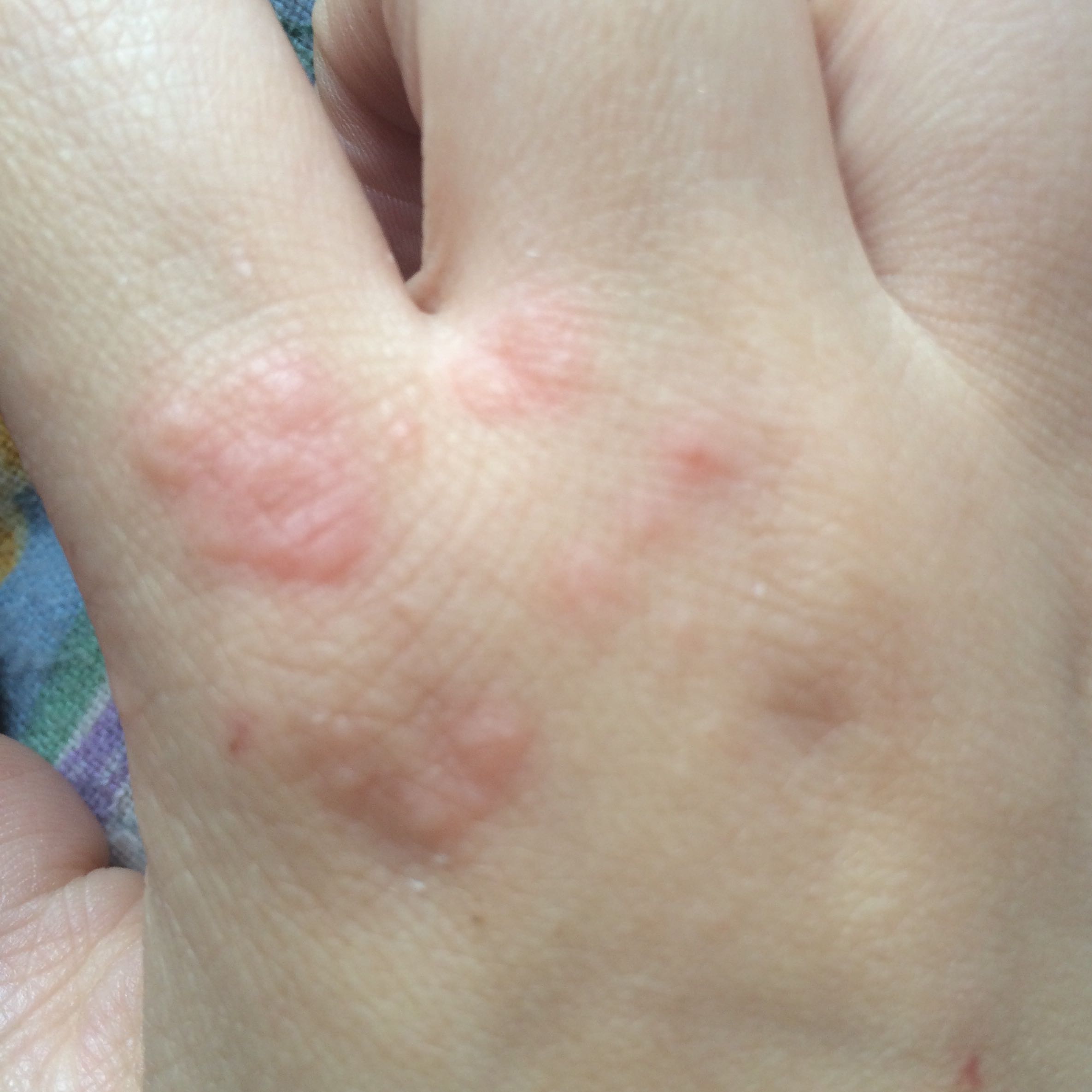Was ist das für ein Ausschlag? (Hand, Juckreiz)