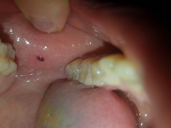 Was ist das? Blase im Mundinnenraum? (Gesundheit und Medizin, Körper, Mund) pickel in der wange innen