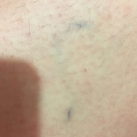 Auf meinem Bein  - (Arzt, Haut, blau)