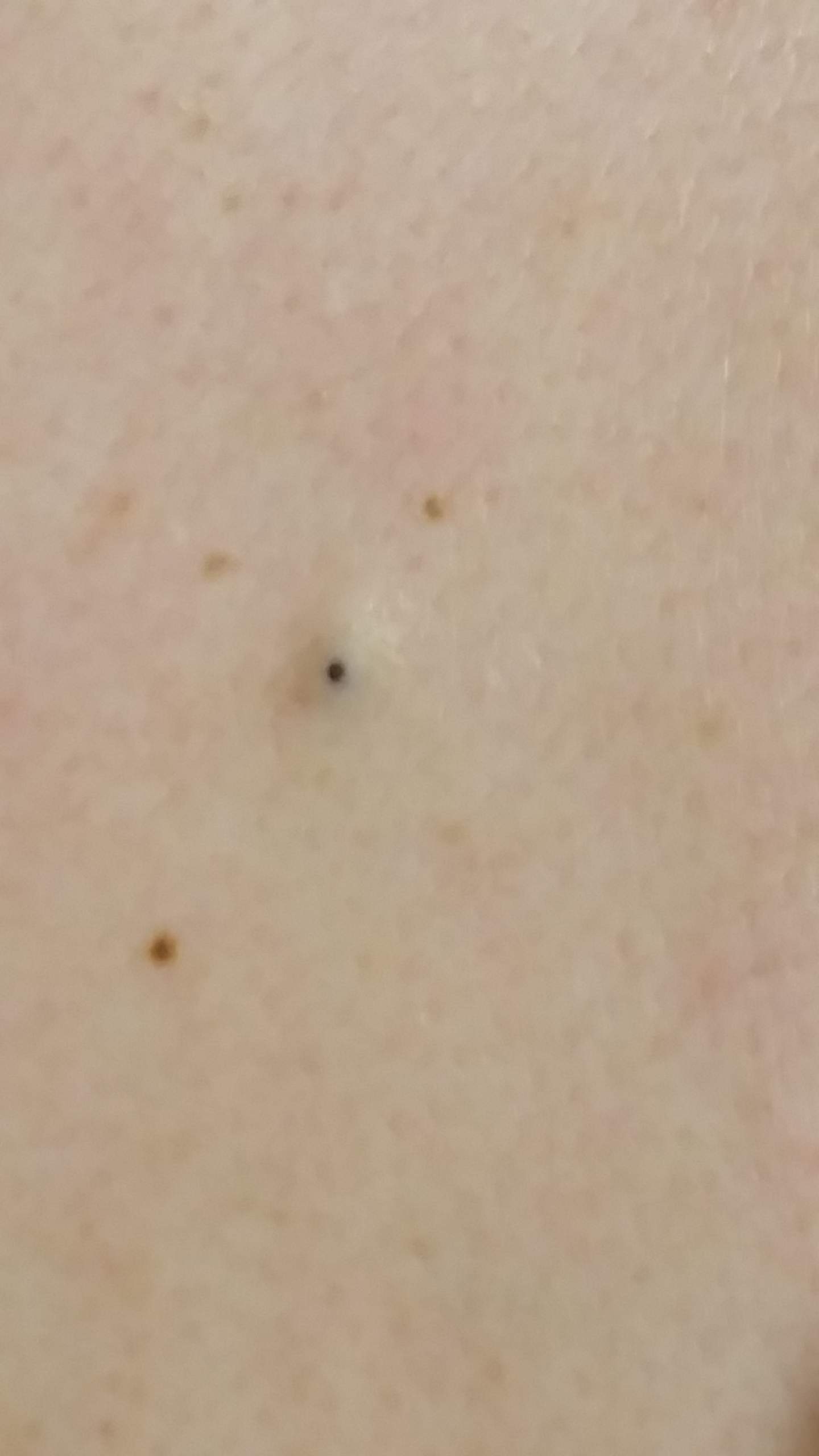 Was Ist Das Bloss Fur Ein Seltsamer Schwarzer Pickel Punkt Gesundheit Was Ist Das Bloss Fur Ein Seltsamer Schwarzer Pickel Punkt Gesundheit