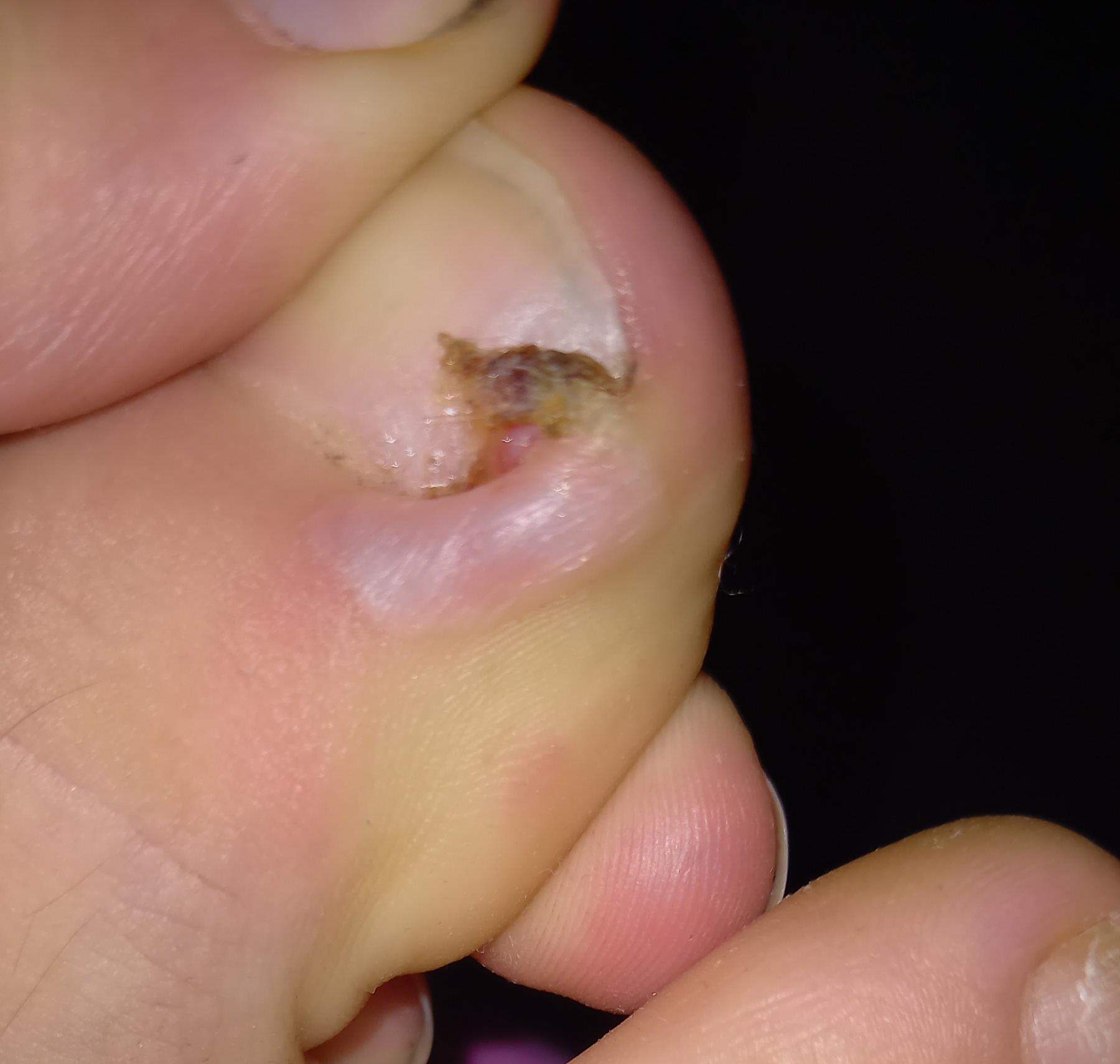 Was ist das da am Zeh (Trigger Warnung)? (Gesundheit und Medizin, Gesundheit, Schmerzen) Was ist das da am Zeh (Trigger Warnung)? (Gesundheit und Medizin, Gesundheit, Schmerzen)