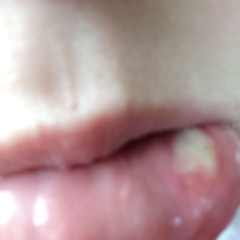 Was Ist Das Da An Meiner Lippe Fur Ein Weisses Ding Entzundung Herpes