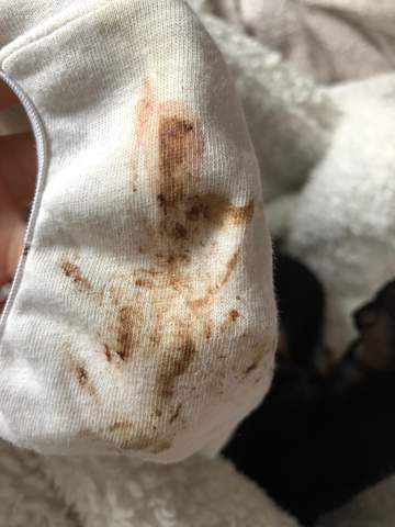 Brauner Ausfluss Nach Periode Brauner Ausfluss Nach Periode