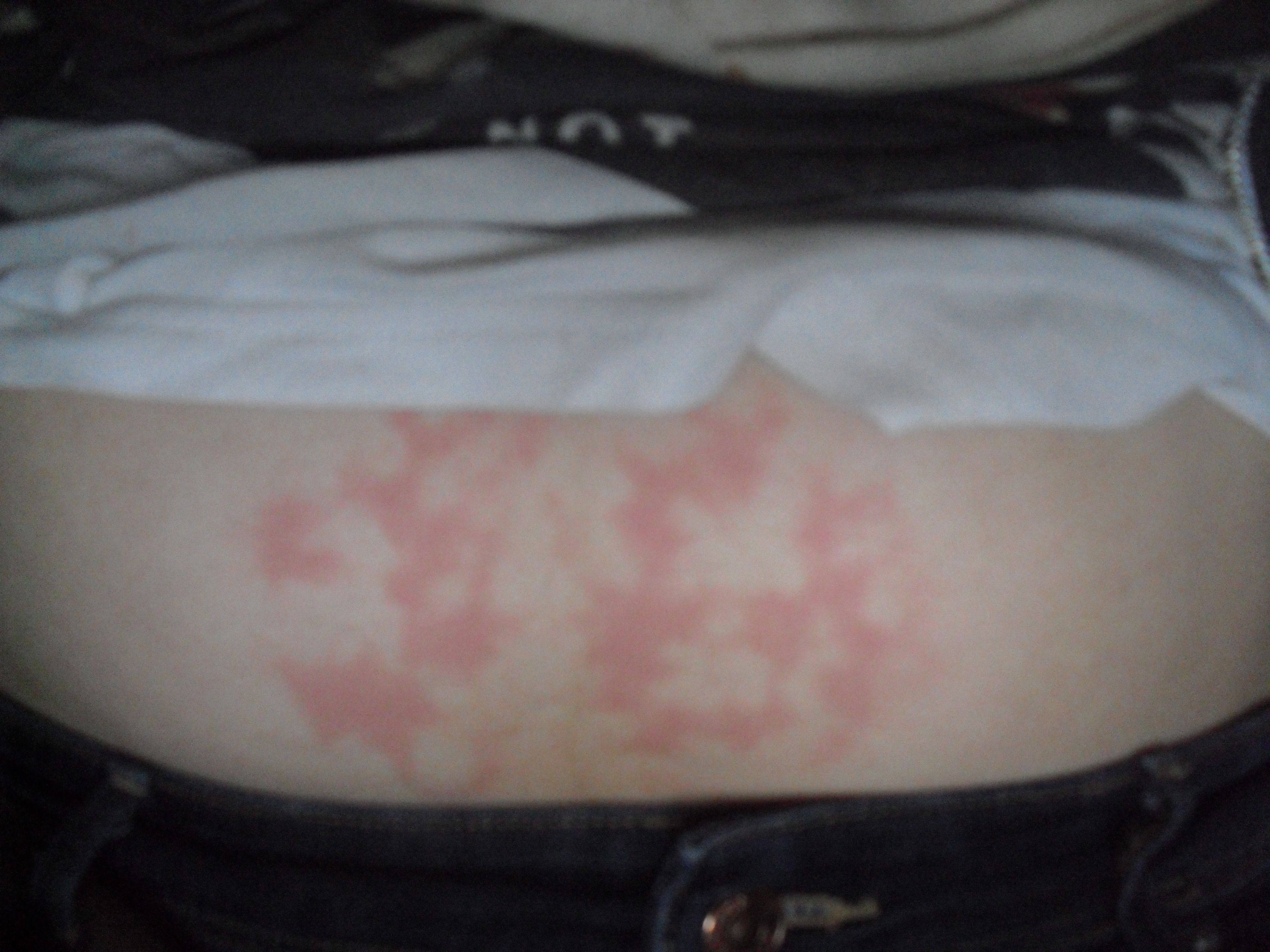 Rote Flecken Nach Wärmflasche Gehen Nicht Weg www.gutefrage.net