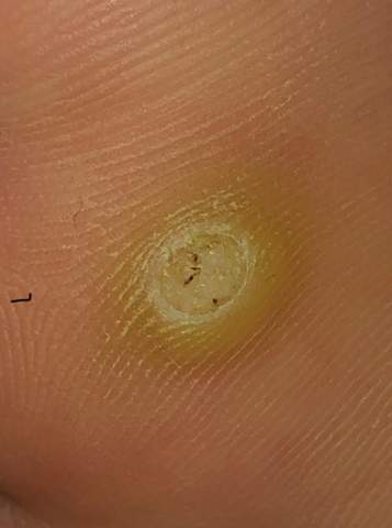 Was Ist Das Dornwarze Oder Huhnerauge Gesundheit Und Medizin Medizin Warzen Was Ist Das Dornwarze Oder Huhnerauge Gesundheit Und Medizin Medizin Warzen